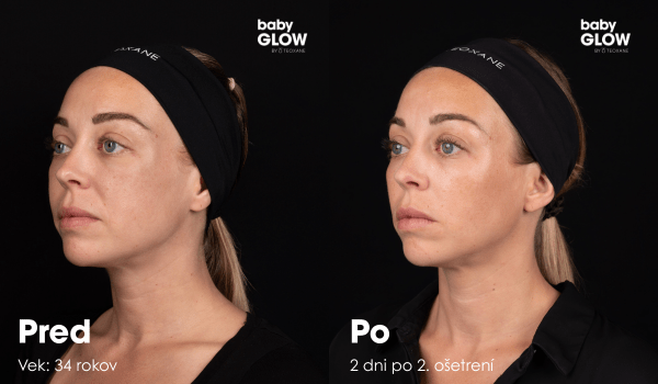 Výsledky pre a po babyGLOW by TEOXANE