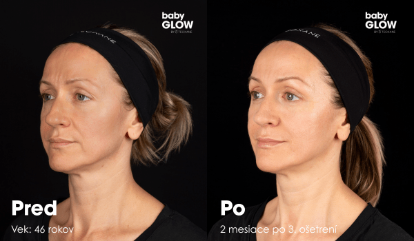 Výsledky pre a po babyGLOW by TEOXANE